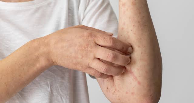 MPOX ( VARÍOLA DOS MACACOS ), CHEGOU  A PAÍSES FORA DO CONTINENTE AFRICANO E PREOCUPA OMS